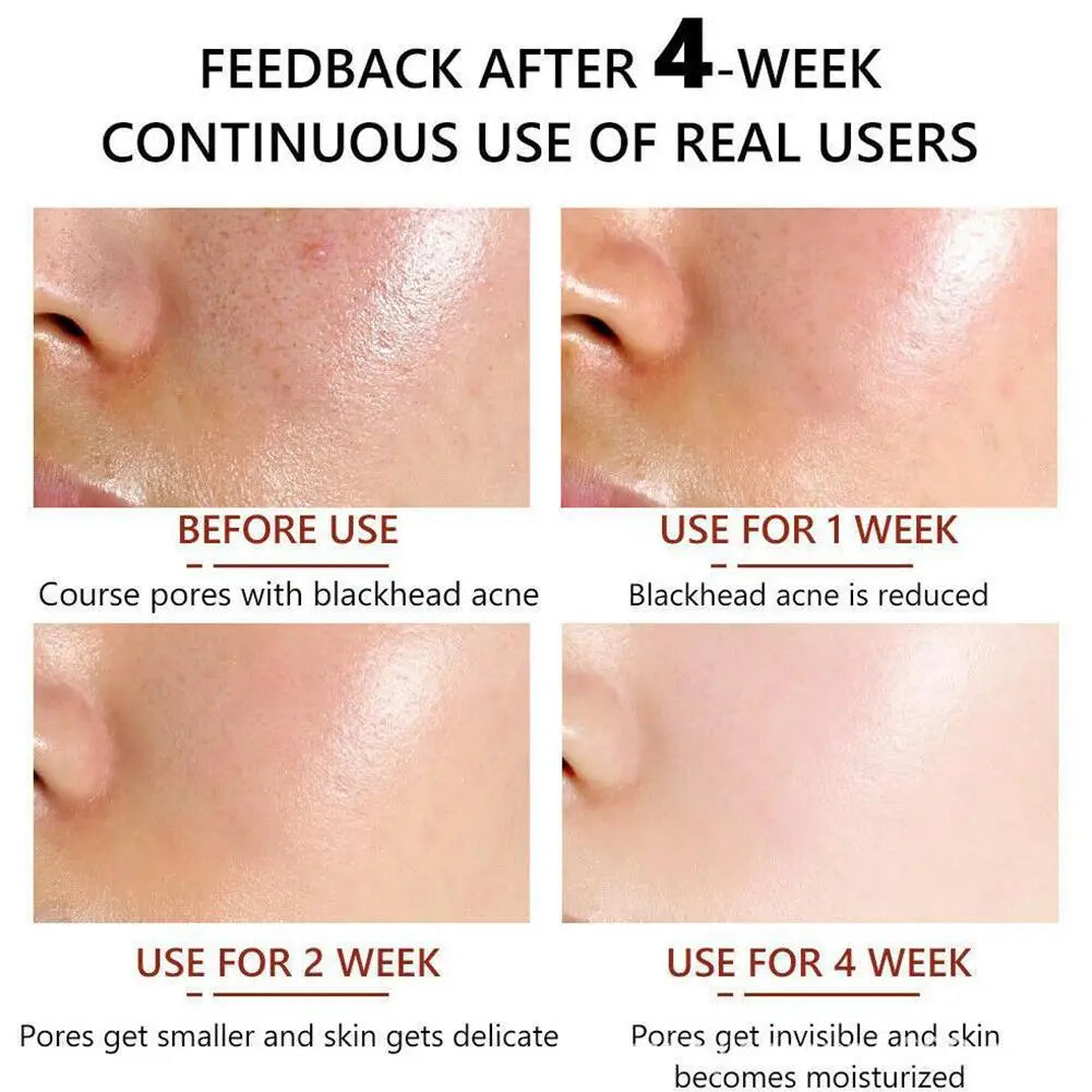 Salicylic Acid Pore Shrinking Essence Anti-acne Exfoliating Blackhead Remover Face Spot Removal Essence Beauty Health Skin Care