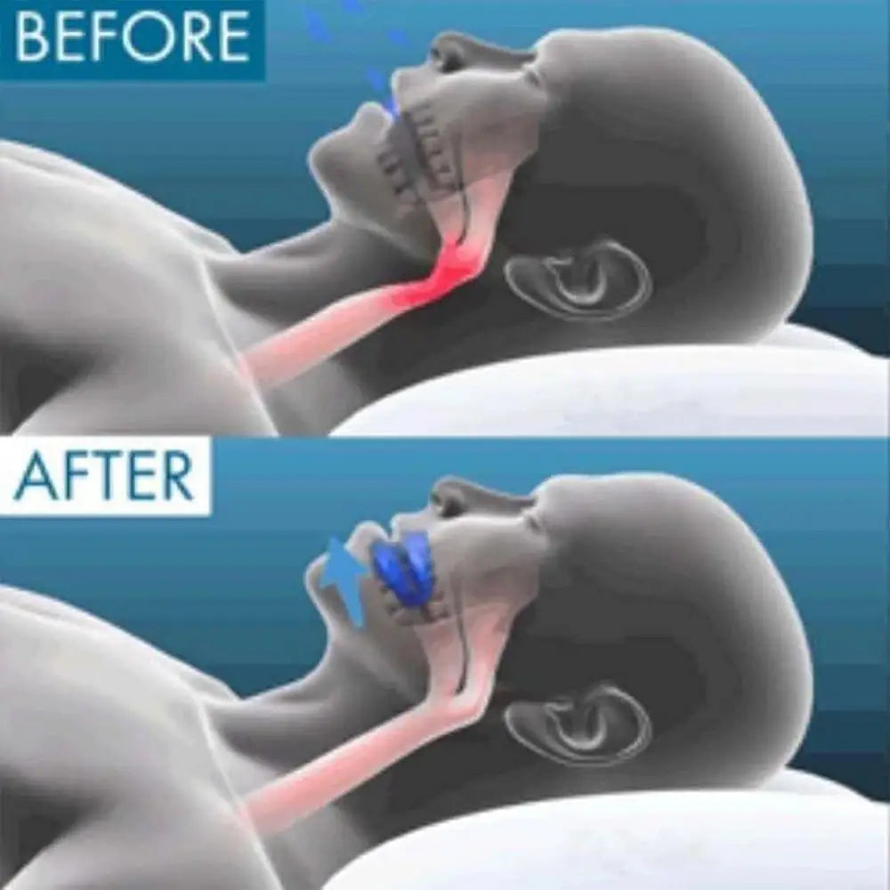 Anti Snoring Mouthpiece Reusable Snore Device Stopper Reduce Snoring Aid Snore Solution Gum Shield for Snoring Stop tool