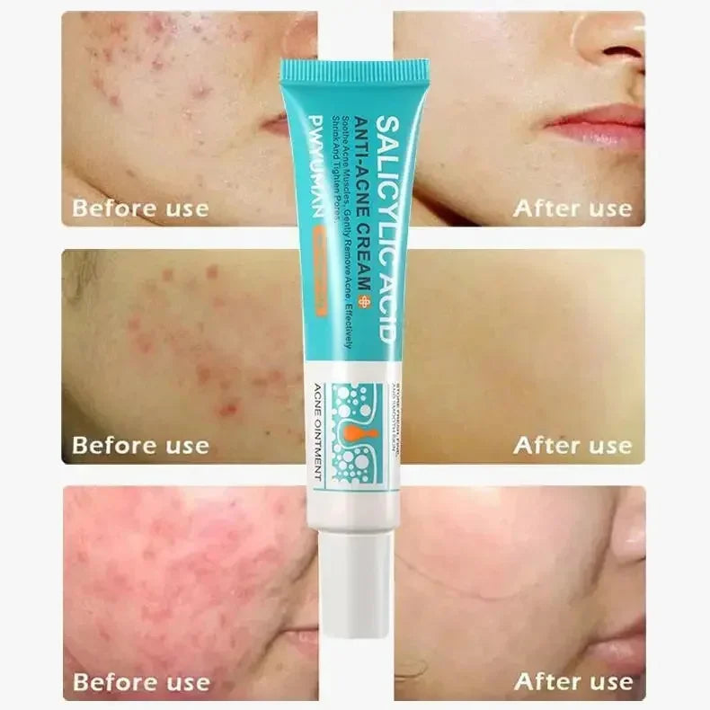 Salicylic Acid Acne Removal Cream Repair Pimple Spots Deep Cleaning Pore Shrinking Oil Control Whitening Moisturizing Skin Care