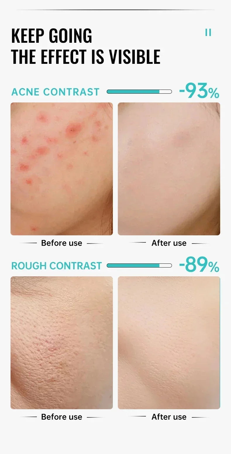 Salicylic Acid Acne Removal Cream Repair Pimple Spots Deep Cleaning Pore Shrinking Oil Control Whitening Moisturizing Skin Care