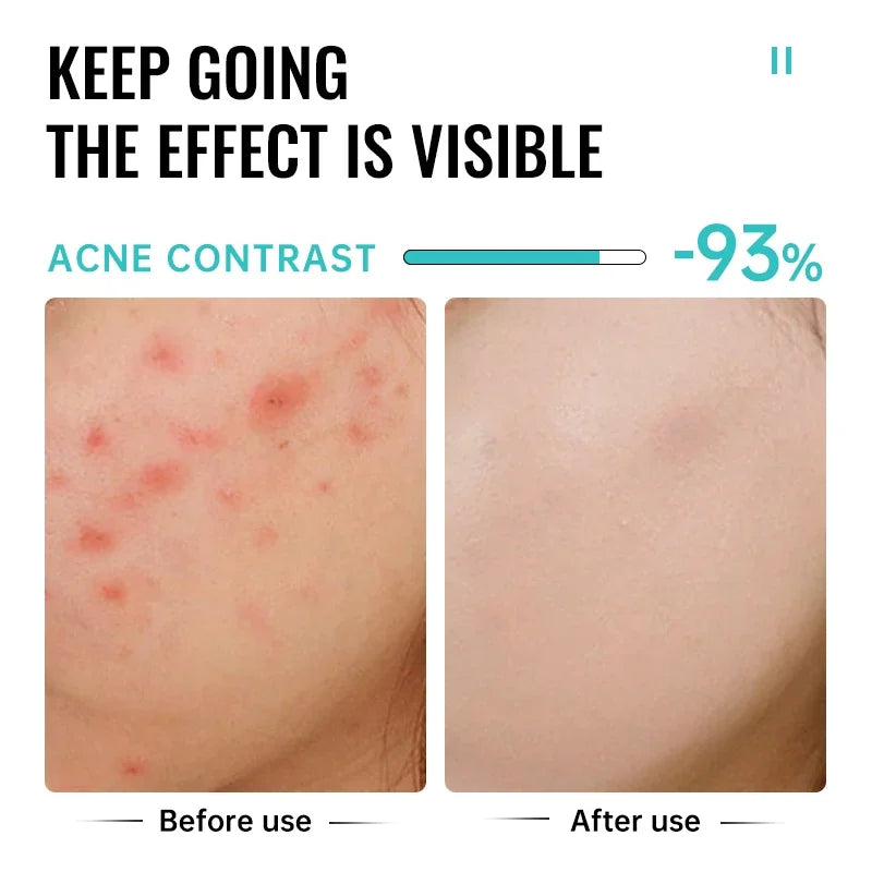 Salicylic Acid Acne Removal Cream Repair Pimple Spots Deep Cleaning Pore Shrinking Oil Control Whitening Moisturizing Skin Care